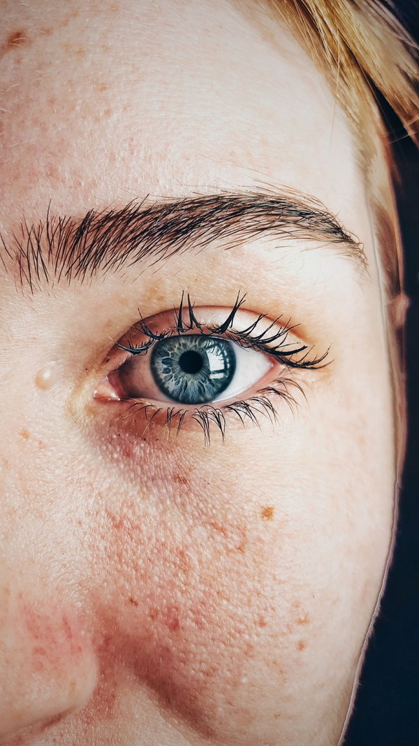 Augen im Stress: Tränende Augen können zum Problem werden
