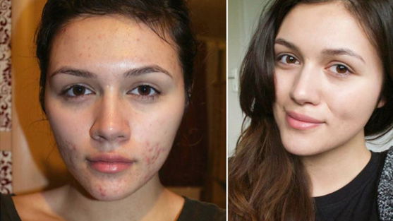 GNTM-Kandidatin Anna Maria Damm spricht über ihre Akne