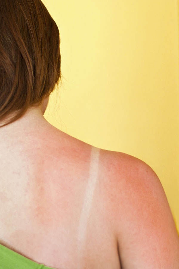 Grüner Tee gegen Sonnenbrand