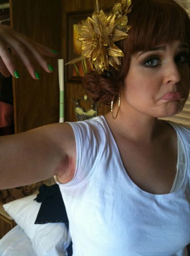 Twitpic Kelly Osbourne mit Ausschlag