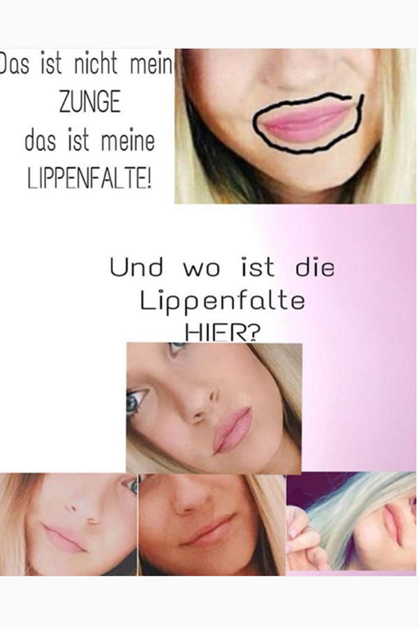 Dagis Lippenfalte