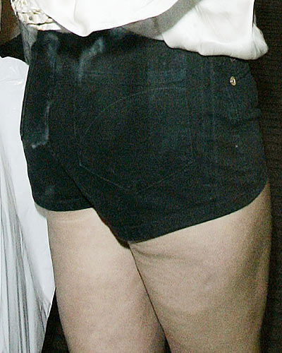Dellen bei Kate Moss