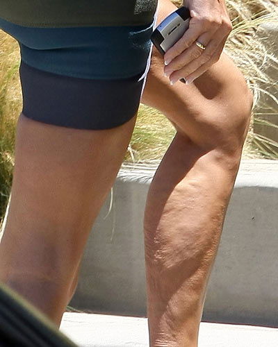 Cellulite bei Victoria Beckham