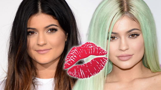 Wird Kylie Jenner bald wieder natürliche Lippen haben?