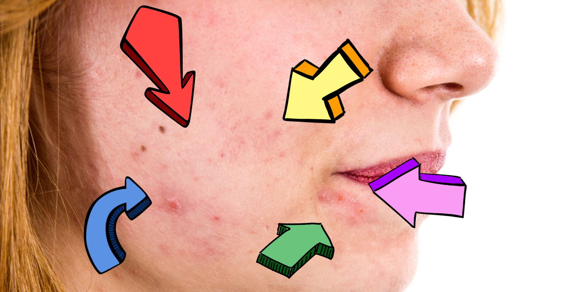 YouTuberin mit Akne zeigt sich einen Monat ohne Make-up