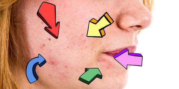 YouTuberin mit Akne zeigt sich einen Monat ohne Make-up