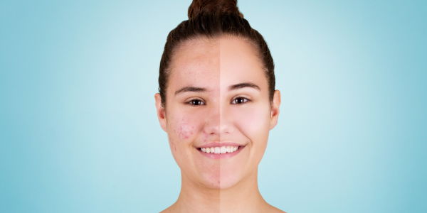 Beauty-Bloggerin bekommt Akne wegen Spirale