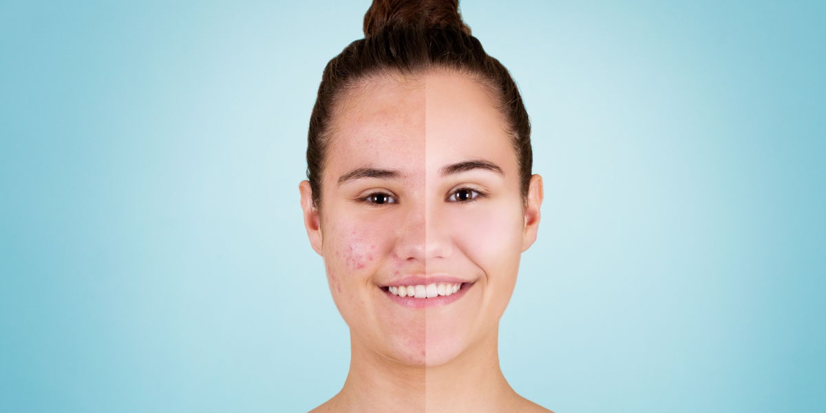 Beauty-Bloggerin bekommt Akne wegen Spirale