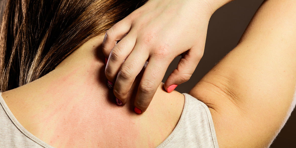 Allergische Hautreaktion: Das passiert, wenn du neue Klamotten vor dem ersten Tragen nicht wäschst