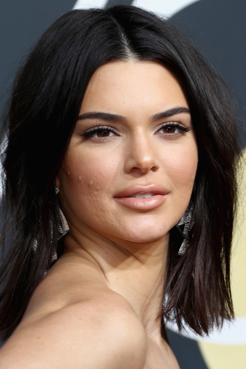 Kendall Jenner: Akne
