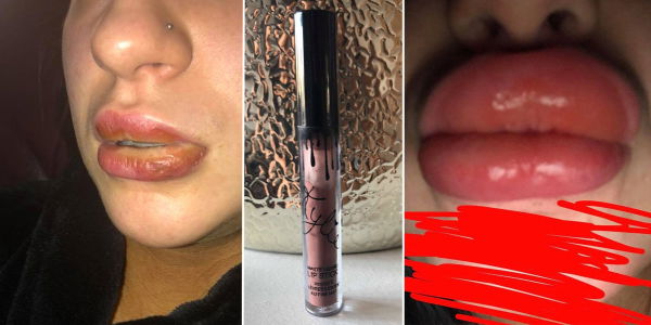 Kylie Jenner Lipstick Fake bringt 18-Jährige ins Krankenhaus
