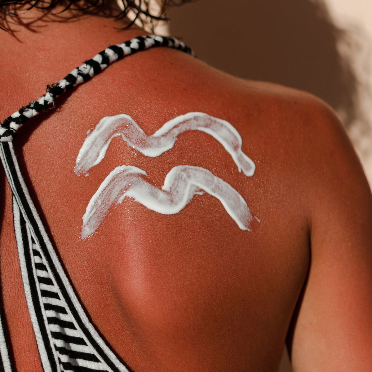 …ich einen leichten Sonnenbrand habe?